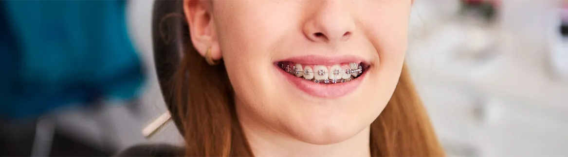 who-are-the-children palate expander kids
