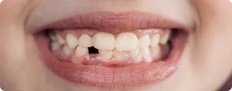 Why people might have missing teeth 
