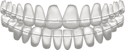 clearbracesic