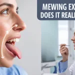 Mewing Explained: Does It Actually Work or When to Consult an Orthodontist